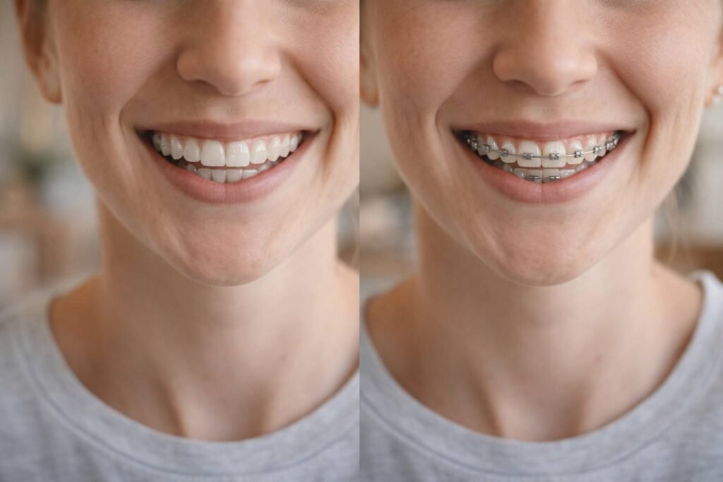 Comfort and Daily Wear Compared to Braces